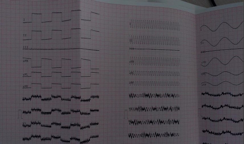 异样心电图.JPG